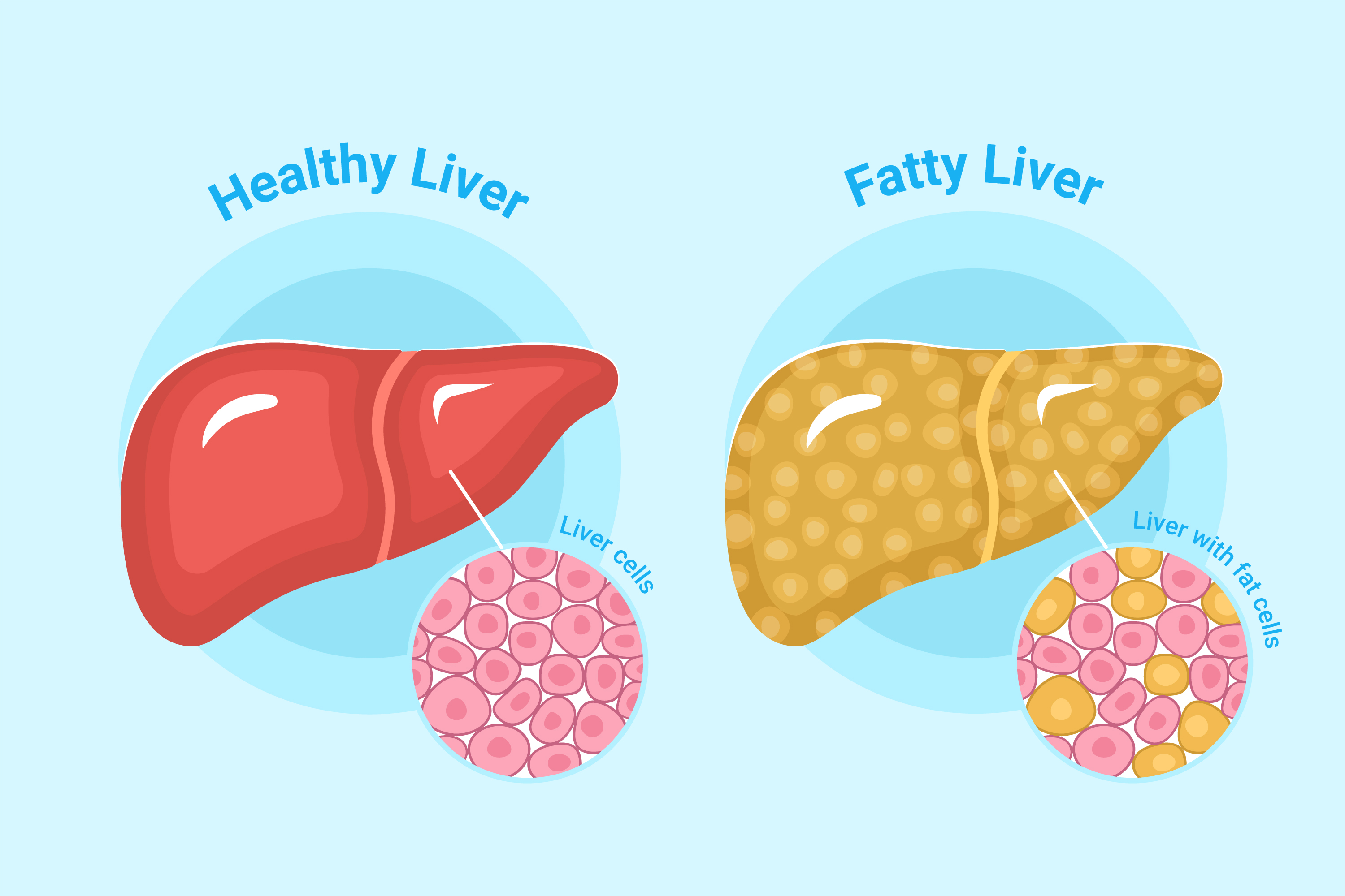 How Ayurvedic Medicine For Fatty Liver Supports and Reduces Fat Accumulation